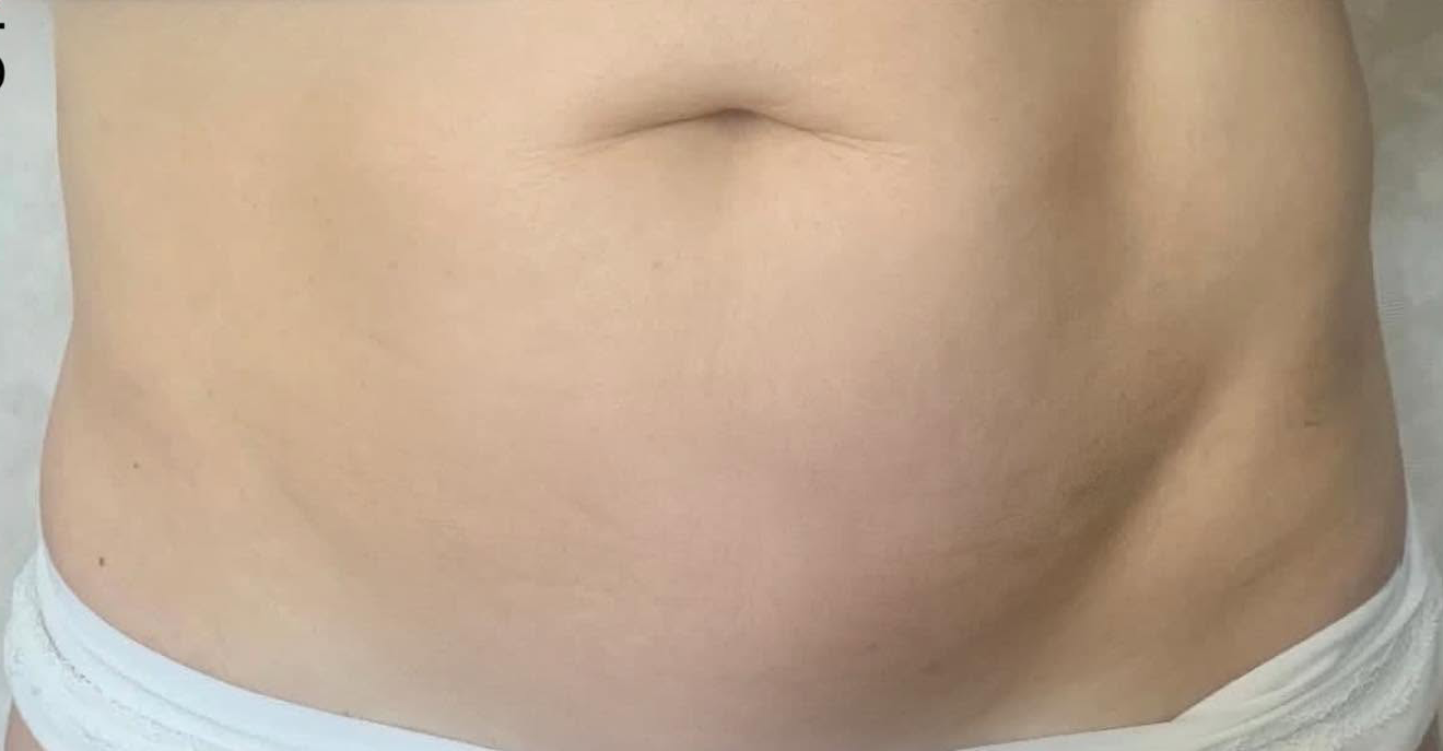 Body Lifting after 1