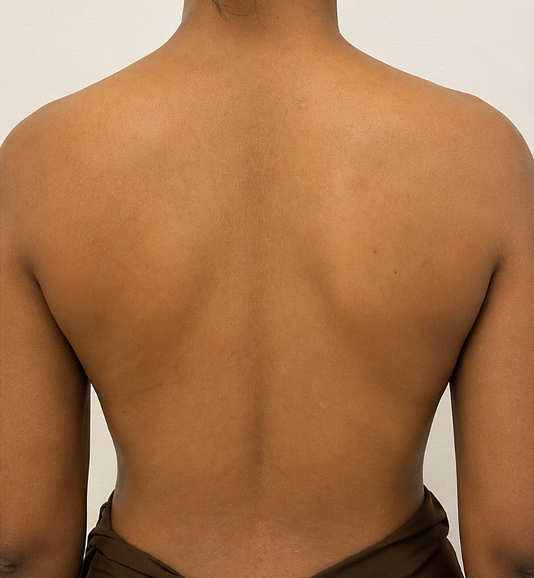 Hyperpigmentation after 4