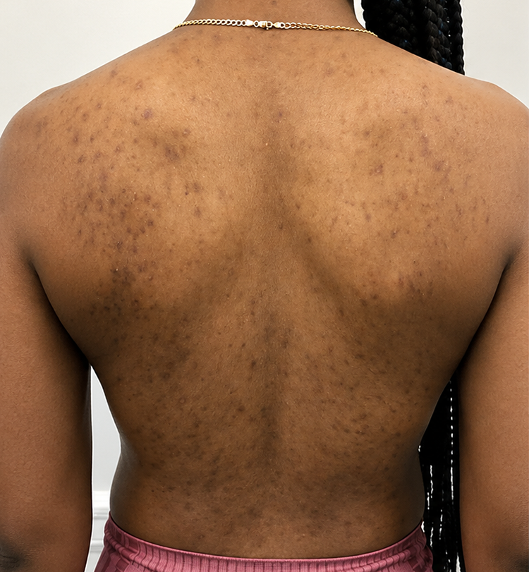 Hyperpigmentation before 4