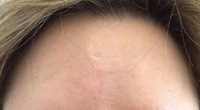 Scar-Removal after