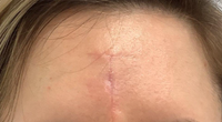 Scar-Removal before
