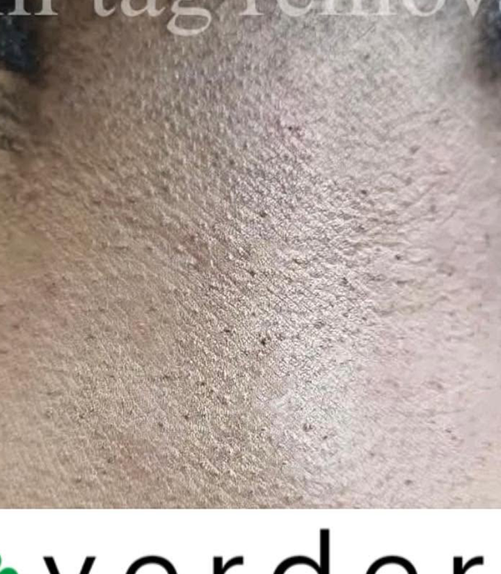 Skin tag after 2