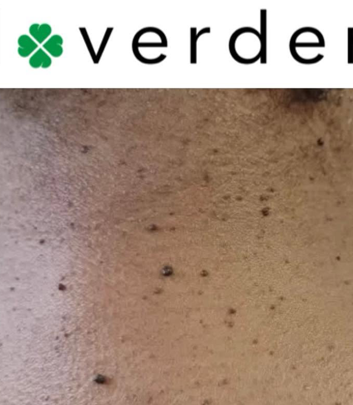 Skin tag before 2