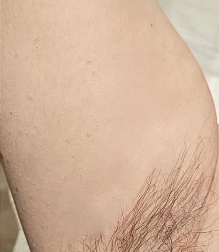 Skin tags after