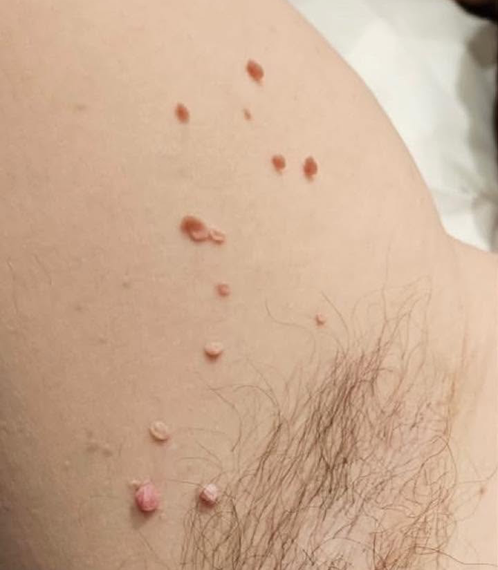 Skin tags before
