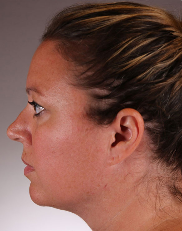 non-invasive facial contouring after 1