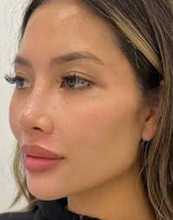 non-invasive facial contouring after 2