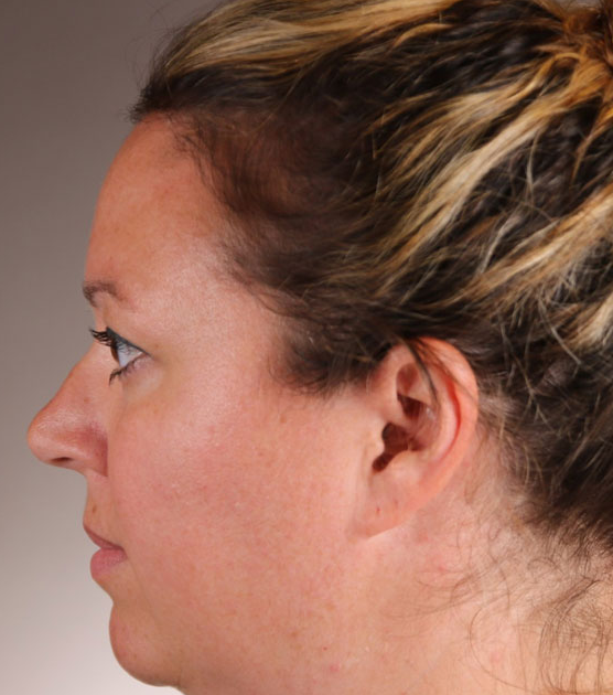 non-invasive facial contouring before 1