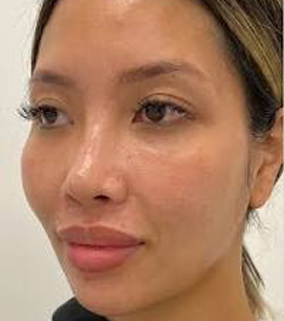 non-invasive facial contouring before 2
